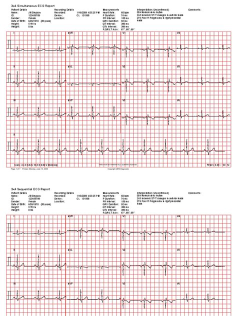 normal ecg sample|normal ecg report sample.
